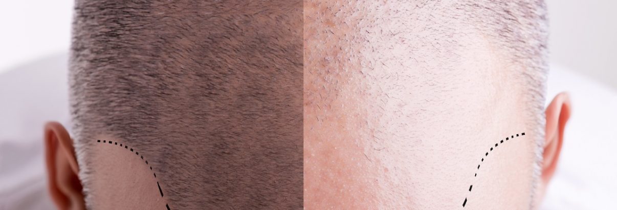 Tricopigmentation à Toulouse
