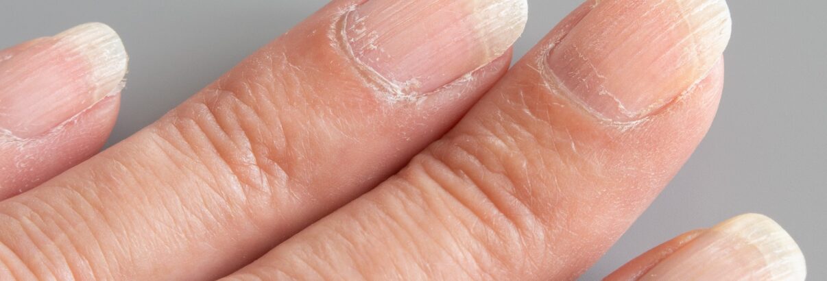 Les ongles striés : causes et solutions pour les traiter